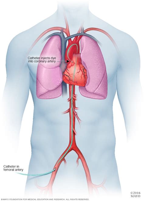 Cardiac Catheterization and Coronary Angiography